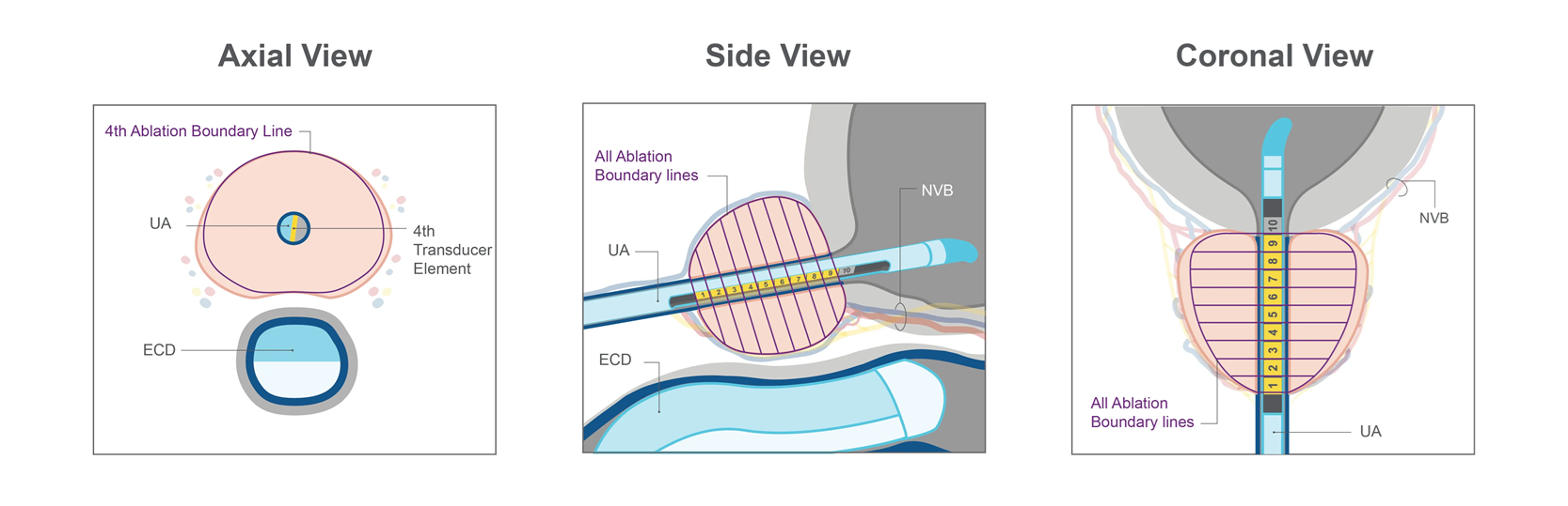 TULSA-PRO MRI Thermometry Images